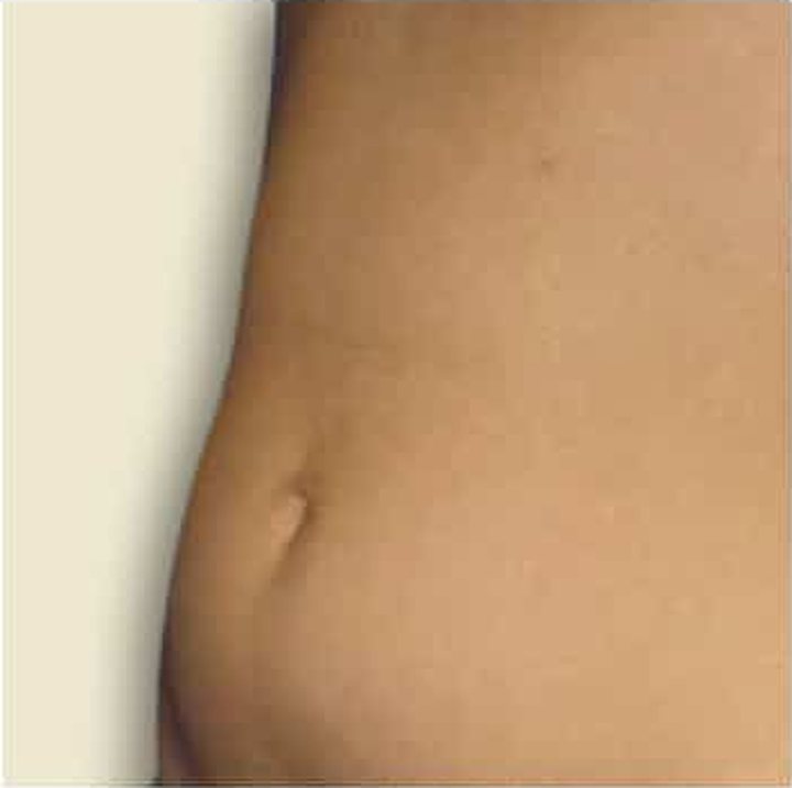 After treatment