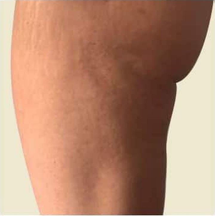 After treatment