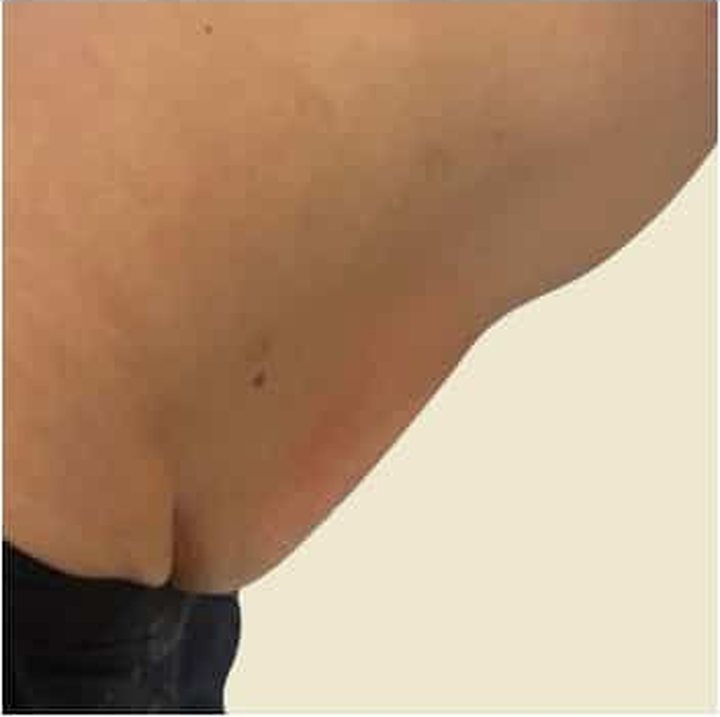 After treatment