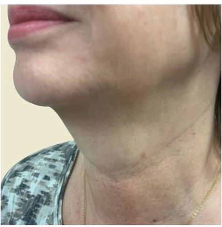 After treatment