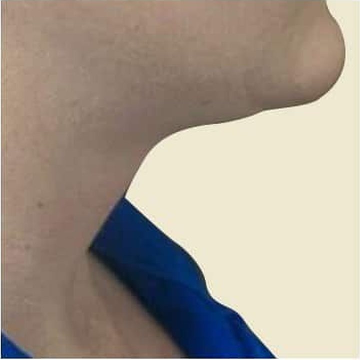 After treatment
