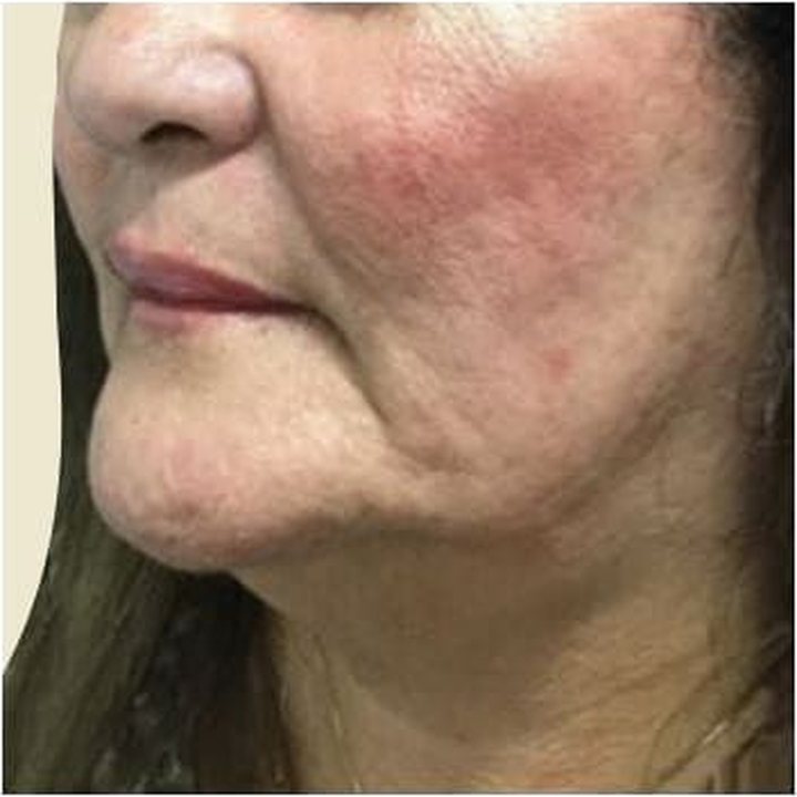 After treatment