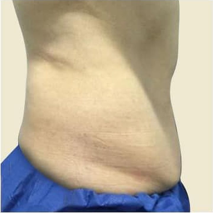 After treatment