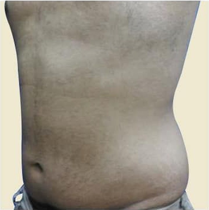 After treatment