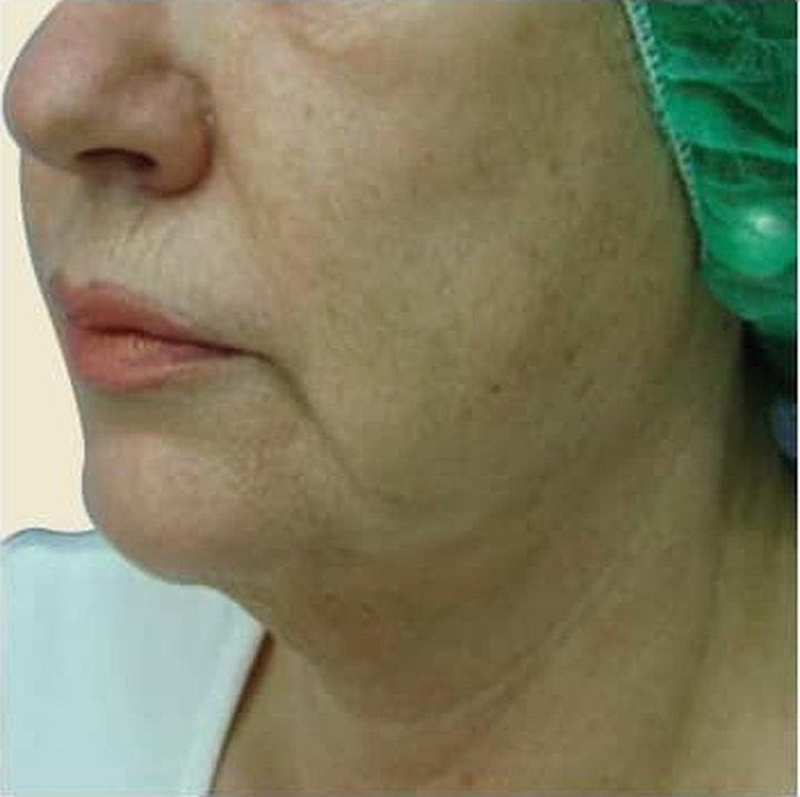 After treatment