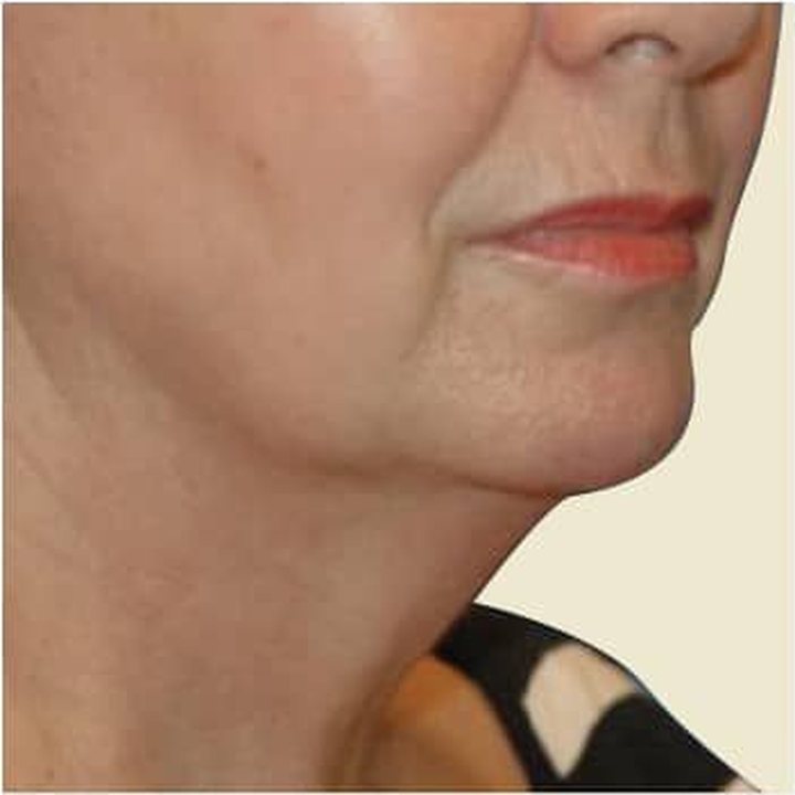 After treatment