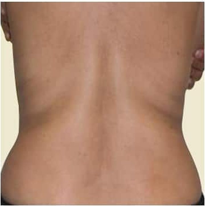 After treatment