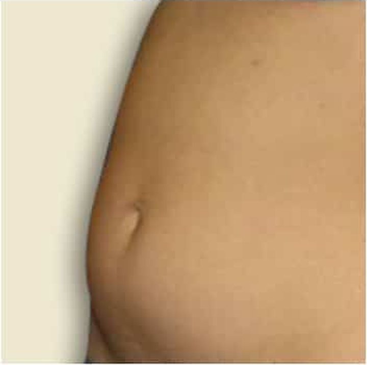 Before treatment