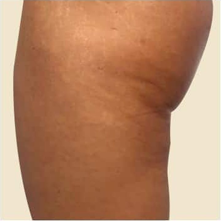 Before treatment