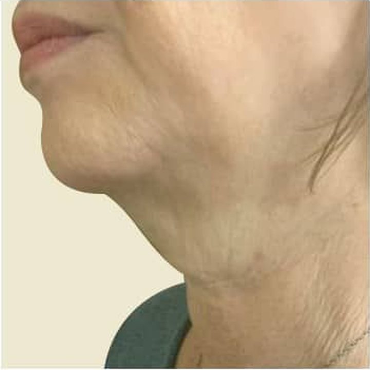 Before treatment