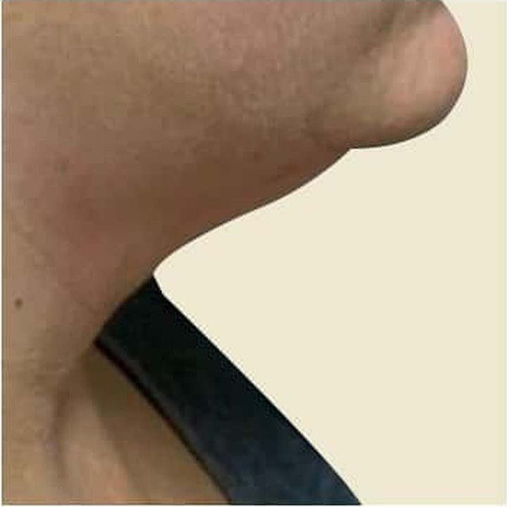 Before treatment
