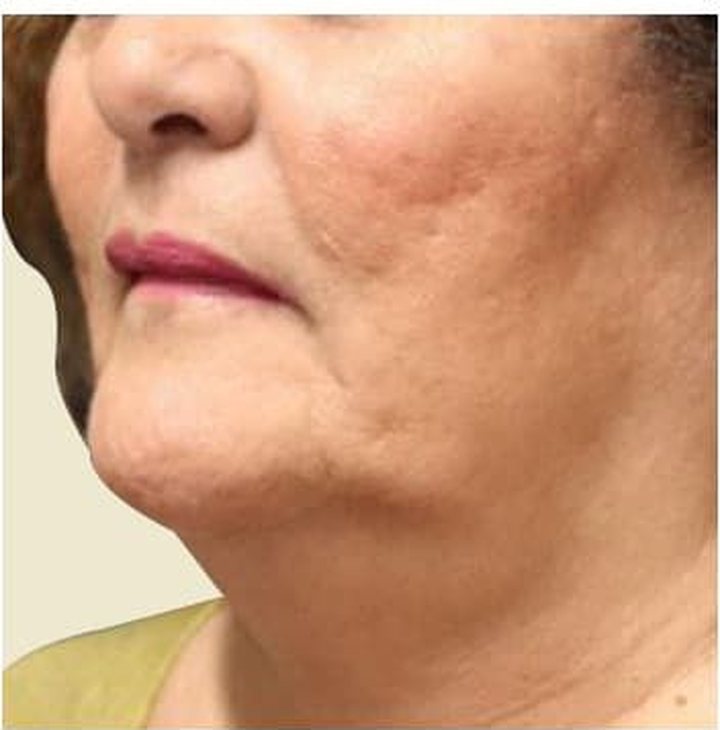 Before treatment