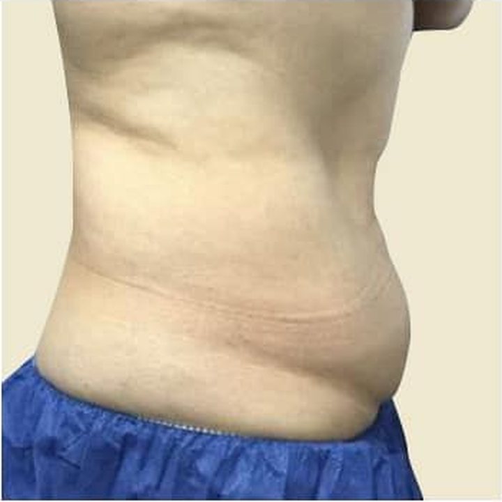 Before treatment