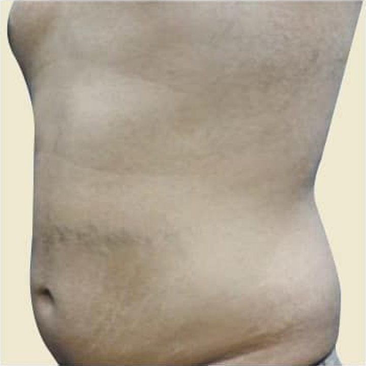 Before treatment
