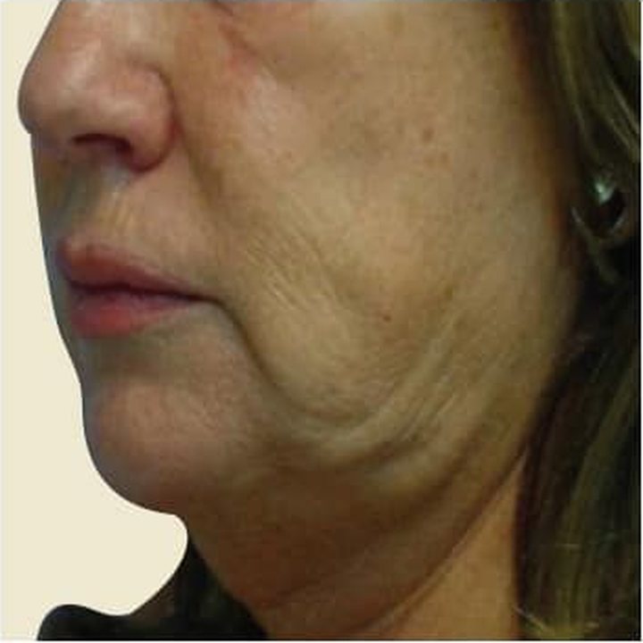 Before treatment