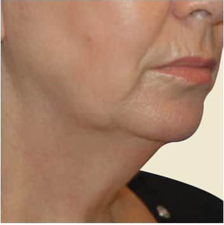 Before treatment
